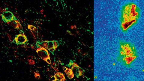 Neuronas afectadas, a la izquierda, y reduccin progresiva de la protena clave en la enfermedad tras el tratamiento (derecha)