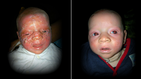 Jeremiah, el primer beb albino que Mafalda Soto sostuvo en brazos. Con tres semanas de vida lleg al hospital donde trabajaba la gallega en Malawi con la cara abrasada.