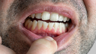 Las encas inflamadas y el sangrado de estas son signos de gingivitis.