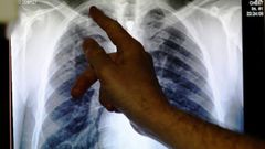 Radiografía de un paciente con tuberculosis