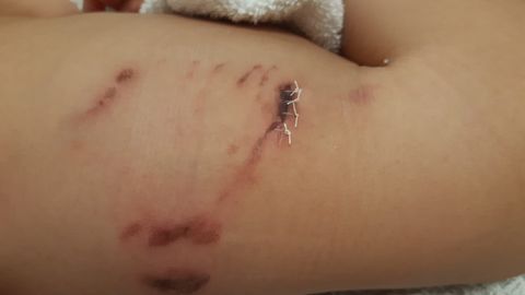 Las heridas del beb tras el ataque del perro