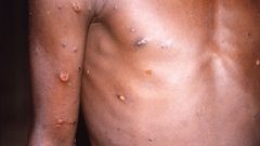 Uno de los síntomas de la viruela del mono son las erupciones en la piel