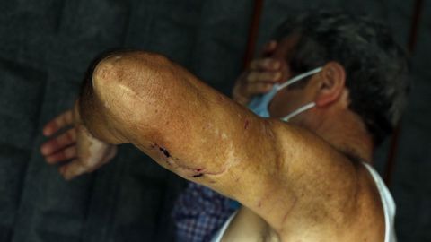 El hombre muestra las heridas que sufri en uno de los brazos