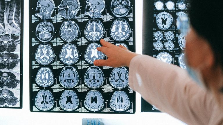 Varapalo para la gran esperanza contra el alzhéimer: el fármaco no tiene beneficios clínicos, pero sí efectos adversos