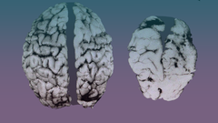 Comparacin de dos cerebros de dos nios de seis semanas de edad. El de la izquierda es un cerebro normal y el de la derecha sufre de Sndrome Alcohlico Fetal