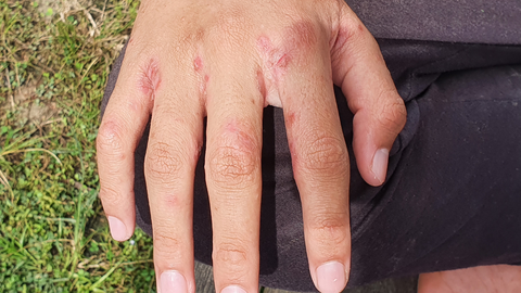 Las lesiones cut�neas que provoca la sarna.